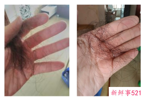 最近掉头发严重是什么原因