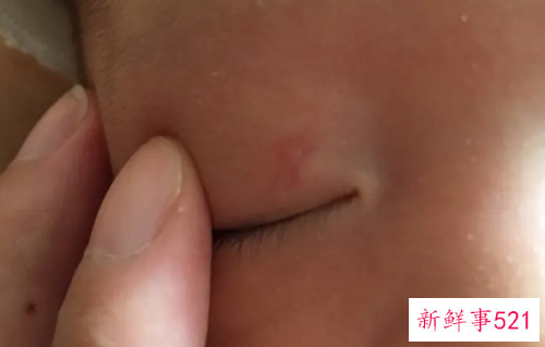 婴儿眼皮红印多久会好