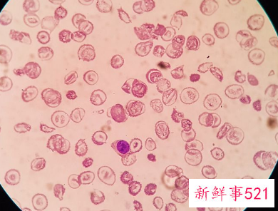 妇科病外阴瘙痒白带豆腐渣吃什么药