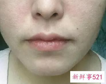 脸上出现一块一块的干皮