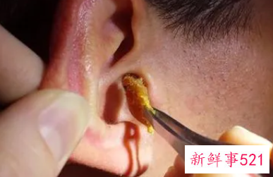 医院有专门清理耳屎的吗