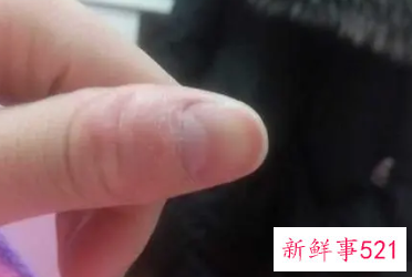 强迫性皮肤剥离症的表现