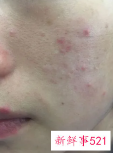 脸上长了粉刺怎么治