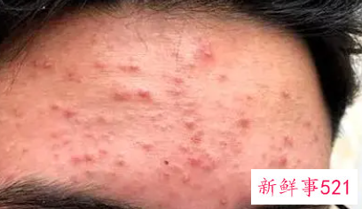 为什么不停的长痘