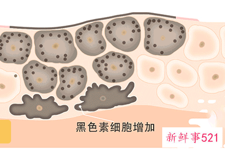 全脸都是雀斑怎么办