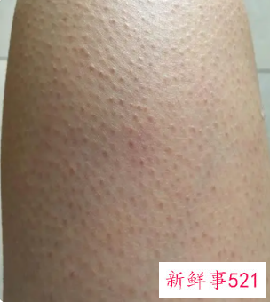 女生身上的鸡皮疙瘩怎样去除