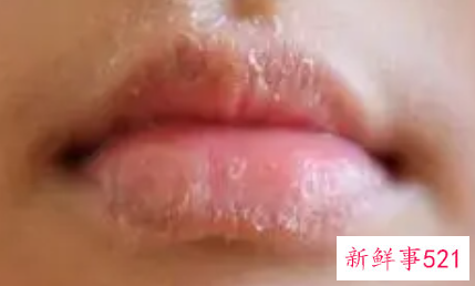 治疗宝宝皮肤干的措施有哪些