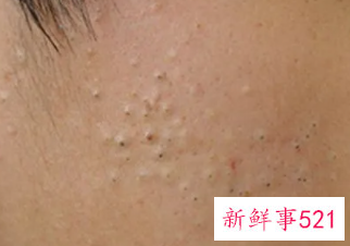 闭合性粉刺是什么