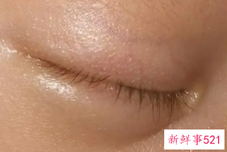新生儿眼皮肿是什么原因