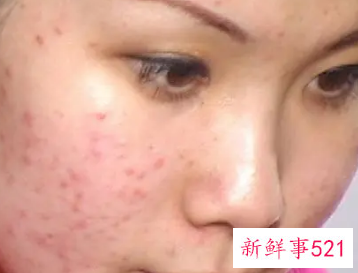 未成年脸上长痘痘怎么调理