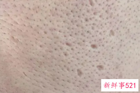 毛孔粗大应该怎么办呢
