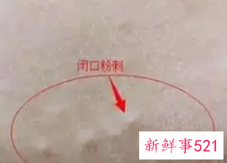 闭合性粉刺是什么