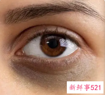 黑眼圈好几年了非常严重怎么解决