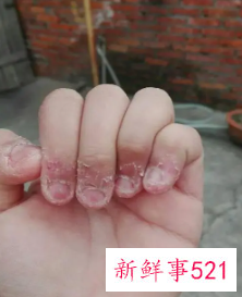 小孩经常咬手指甲