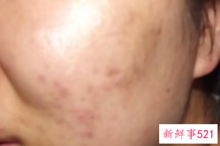 脸上长暗疮是什么原因引起的
