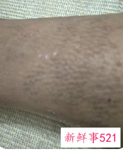 小腿黑色素斑块怎么去除