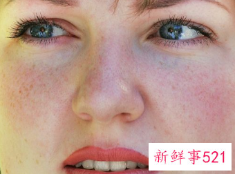 未成年脸上长痘痘怎么调理