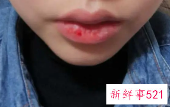 强迫性皮肤剥离症的表现