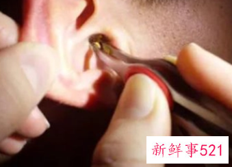 医院有专门清理耳屎的吗