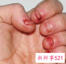 小孩经常咬手指甲
