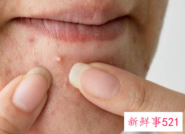 粉刺是什么原因长出来的