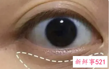 黑眼圈好几年了非常严重怎么解决