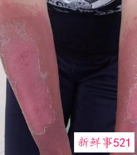 皮肤晒伤了要怎么办