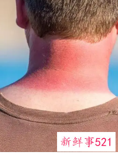 皮肤晒伤了要怎么办