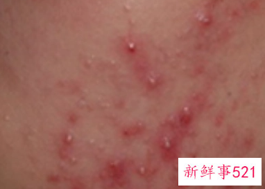 为什么不停的长痘