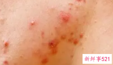 为什么不停的长痘