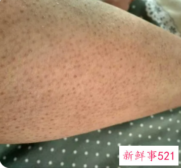 女生身上的鸡皮疙瘩怎样去除