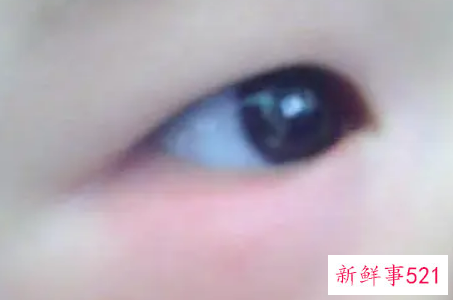 新生儿眼皮肿是什么原因
