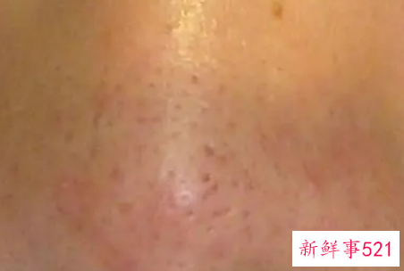 毛孔粗大应该怎么办呢