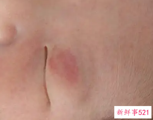 婴儿眼皮红印多久会好