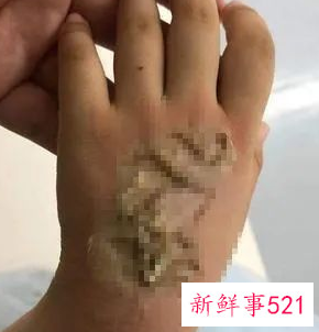 触目惊心！电话手表自燃4岁女童手背被烧伤