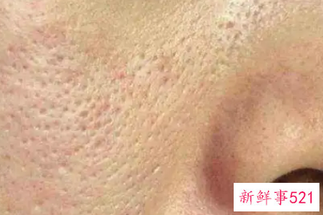 毛孔粗大应该怎么办呢
