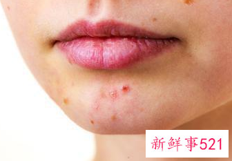 粉刺是什么原因长出来的