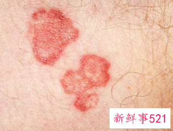 男性得性疾病后八大症状图片