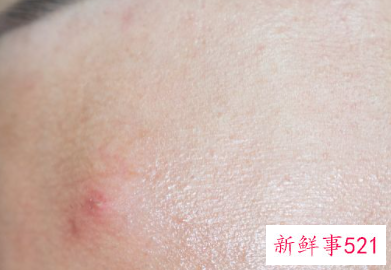 脸上出现一块一块的干皮