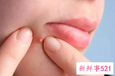 强迫性皮肤剥离症的表现