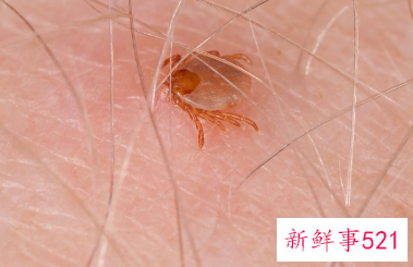 床上螨虫咬的症状