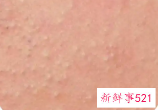 闭合性粉刺是什么