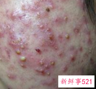 脸上长了粉刺怎么治