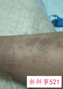 小腿黑色素斑块怎么去除