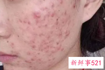 为什么不停的长痘