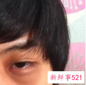 黑眼圈好几年了非常严重怎么解决