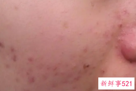 脸上长暗疮是什么原因引起的