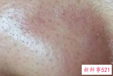 毛孔粗大应该怎么办呢