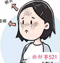 怎么让雀斑消失