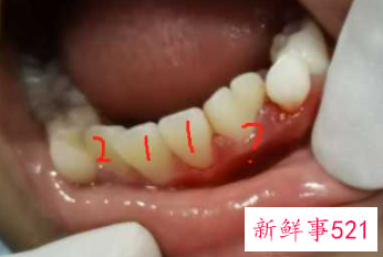 正常情况下人有几颗牙齿